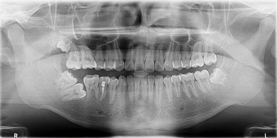曲面断层片怎么看口腔精读 ｜ 一次性教你看懂曲面断层片！_https://www.jmylbn.com_新闻资讯_第10张