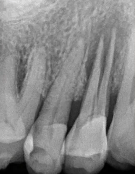 曲面断层片怎么看口腔精读 ｜ 一次性教你看懂曲面断层片！_https://www.jmylbn.com_新闻资讯_第62张