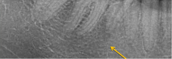 曲面断层片怎么看口腔精读 ｜ 一次性教你看懂曲面断层片！_https://www.jmylbn.com_新闻资讯_第25张