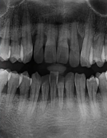 曲面断层片怎么看口腔精读 ｜ 一次性教你看懂曲面断层片！_https://www.jmylbn.com_新闻资讯_第30张