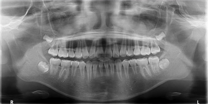 曲面断层片怎么看口腔精读 ｜ 一次性教你看懂曲面断层片！_https://www.jmylbn.com_新闻资讯_第15张