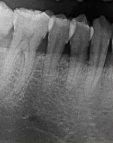 曲面断层片怎么看口腔精读 ｜ 一次性教你看懂曲面断层片！_https://www.jmylbn.com_新闻资讯_第39张