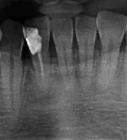 曲面断层片怎么看口腔精读 ｜ 一次性教你看懂曲面断层片！_https://www.jmylbn.com_新闻资讯_第50张