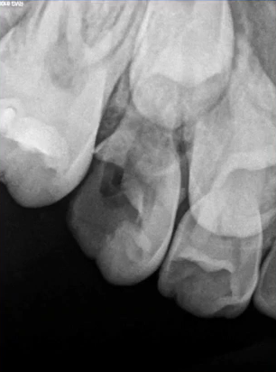 曲面断层片怎么看口腔精读 ｜ 一次性教你看懂曲面断层片！_https://www.jmylbn.com_新闻资讯_第27张