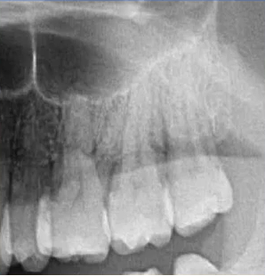 曲面断层片怎么看口腔精读 ｜ 一次性教你看懂曲面断层片！_https://www.jmylbn.com_新闻资讯_第35张