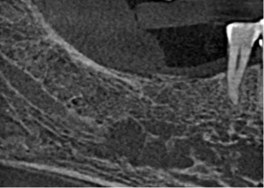 曲面断层片怎么看口腔精读 ｜ 一次性教你看懂曲面断层片！_https://www.jmylbn.com_新闻资讯_第65张