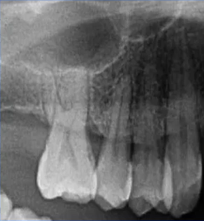 曲面断层片怎么看口腔精读 ｜ 一次性教你看懂曲面断层片！_https://www.jmylbn.com_新闻资讯_第34张