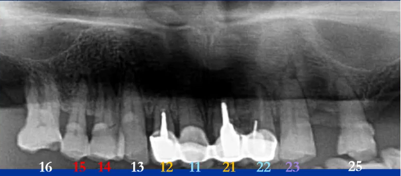 曲面断层片怎么看口腔精读 ｜ 一次性教你看懂曲面断层片！_https://www.jmylbn.com_新闻资讯_第61张