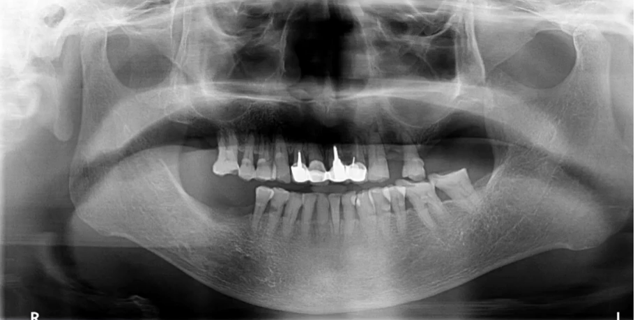 曲面断层片怎么看口腔精读 ｜ 一次性教你看懂曲面断层片！_https://www.jmylbn.com_新闻资讯_第60张