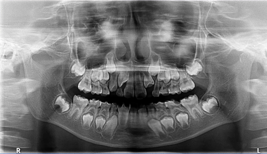 曲面断层片怎么看口腔精读 ｜ 一次性教你看懂曲面断层片！_https://www.jmylbn.com_新闻资讯_第19张