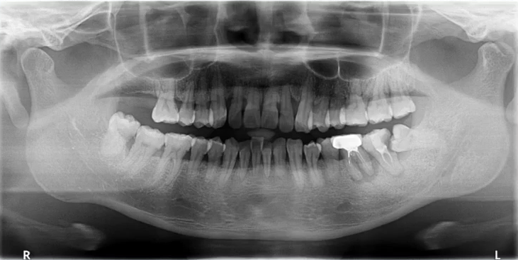 曲面断层片怎么看口腔精读 ｜ 一次性教你看懂曲面断层片！_https://www.jmylbn.com_新闻资讯_第29张