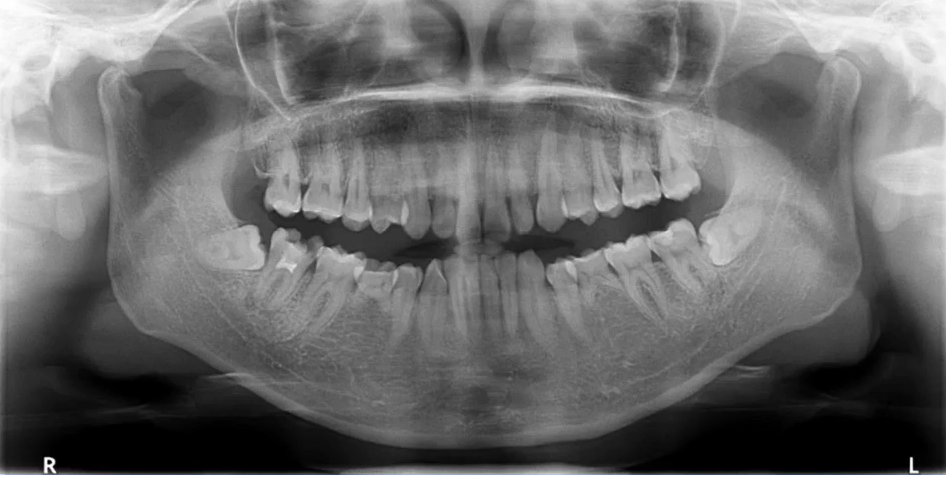 曲面断层片怎么看口腔精读 ｜ 一次性教你看懂曲面断层片！_https://www.jmylbn.com_新闻资讯_第53张