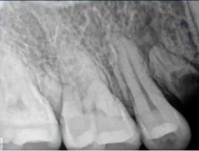 曲面断层片怎么看口腔精读 ｜ 一次性教你看懂曲面断层片！_https://www.jmylbn.com_新闻资讯_第24张