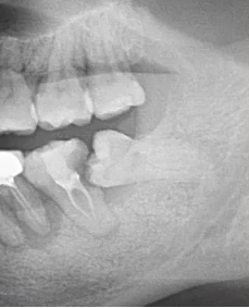 曲面断层片怎么看口腔精读 ｜ 一次性教你看懂曲面断层片！_https://www.jmylbn.com_新闻资讯_第44张