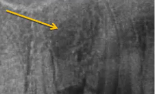 曲面断层片怎么看口腔精读 ｜ 一次性教你看懂曲面断层片！_https://www.jmylbn.com_新闻资讯_第23张