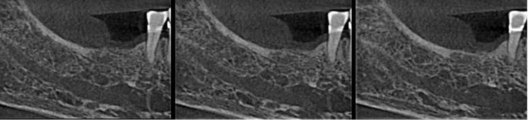 曲面断层片怎么看口腔精读 ｜ 一次性教你看懂曲面断层片！_https://www.jmylbn.com_新闻资讯_第66张