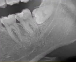 曲面断层片怎么看口腔精读 ｜ 一次性教你看懂曲面断层片！_https://www.jmylbn.com_新闻资讯_第57张