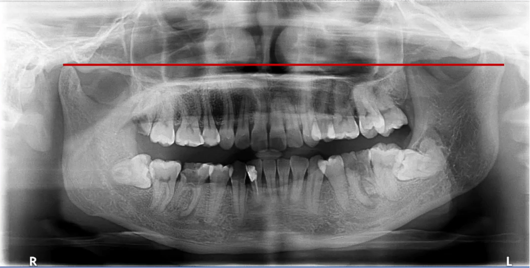 曲面断层片怎么看口腔精读 ｜ 一次性教你看懂曲面断层片！_https://www.jmylbn.com_新闻资讯_第52张