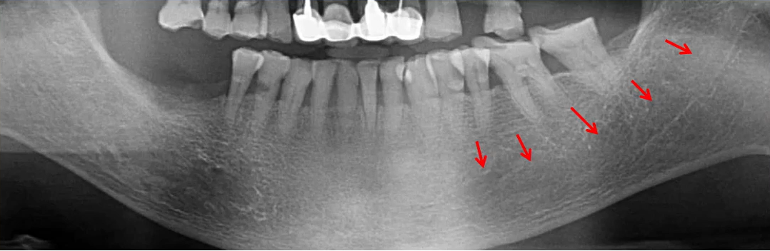 曲面断层片怎么看口腔精读 ｜ 一次性教你看懂曲面断层片！_https://www.jmylbn.com_新闻资讯_第63张