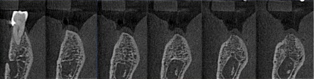 曲面断层片怎么看口腔精读 ｜ 一次性教你看懂曲面断层片！_https://www.jmylbn.com_新闻资讯_第68张