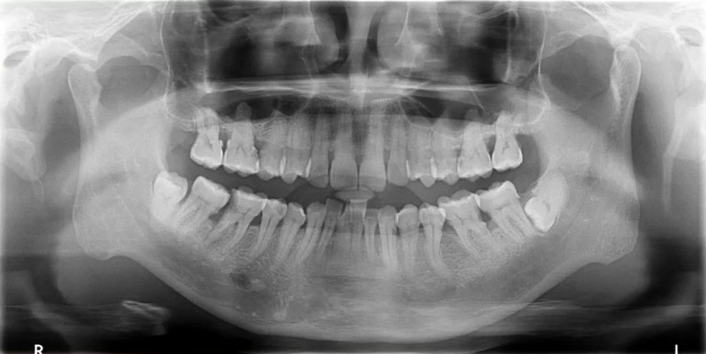 曲面断层片怎么看口腔精读 ｜ 一次性教你看懂曲面断层片！_https://www.jmylbn.com_新闻资讯_第8张