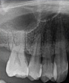 曲面断层片怎么看口腔精读 ｜ 一次性教你看懂曲面断层片！_https://www.jmylbn.com_新闻资讯_第37张