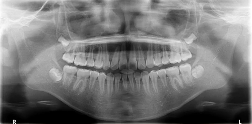 曲面断层片怎么看口腔精读 ｜ 一次性教你看懂曲面断层片！_https://www.jmylbn.com_新闻资讯_第16张