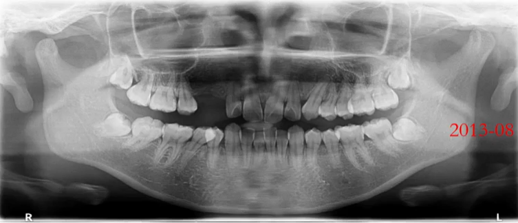 曲面断层片怎么看口腔精读 ｜ 一次性教你看懂曲面断层片！_https://www.jmylbn.com_新闻资讯_第12张