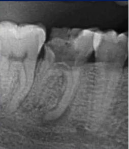 曲面断层片怎么看口腔精读 ｜ 一次性教你看懂曲面断层片！_https://www.jmylbn.com_新闻资讯_第48张