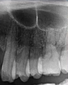 曲面断层片怎么看口腔精读 ｜ 一次性教你看懂曲面断层片！_https://www.jmylbn.com_新闻资讯_第38张