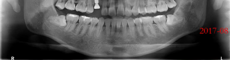 曲面断层片怎么看口腔精读 ｜ 一次性教你看懂曲面断层片！_https://www.jmylbn.com_新闻资讯_第14张