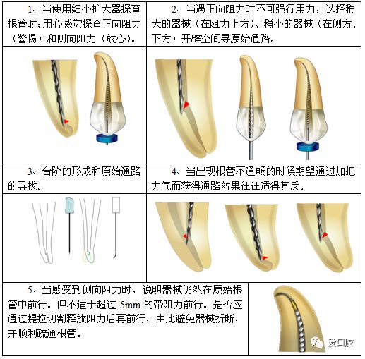 牙胶尖什么颜色根管治疗的标准步骤以及治疗细节的把握_https://www.jmylbn.com_新闻资讯_第37张