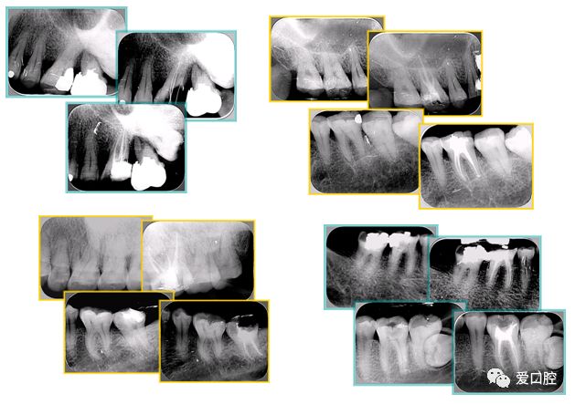牙胶尖什么颜色根管治疗的标准步骤以及治疗细节的把握_https://www.jmylbn.com_新闻资讯_第29张