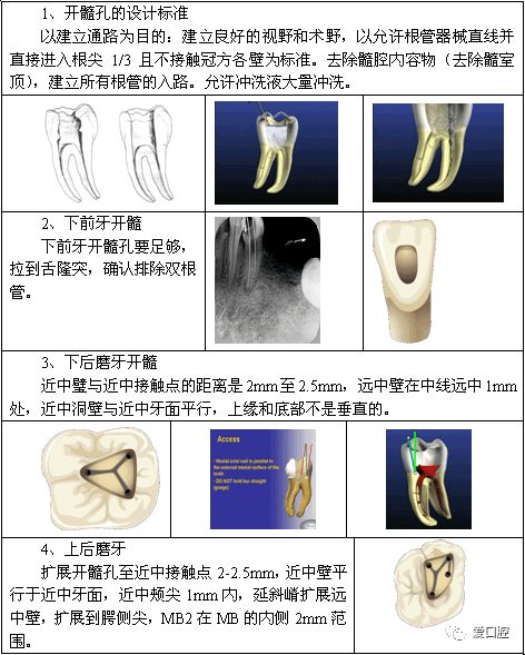 根管治疗标准步骤和细节把握