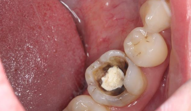深龋治疗的几个要点_医学界-助力医生临床决策和职业成长