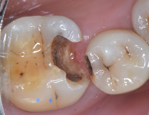 深龋治疗的几个要点_医学界-助力医生临床决策和职业成长