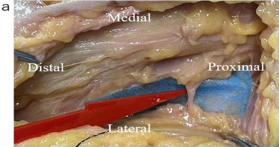DAA全髋置换：关键解剖标志与操作要点