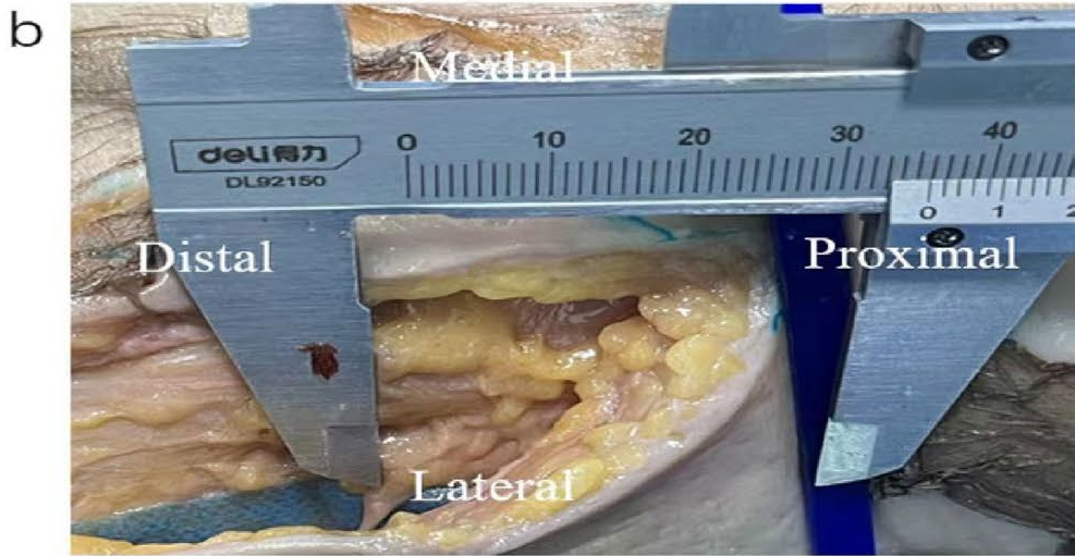 DAA全髋置换：关键解剖标志与操作要点