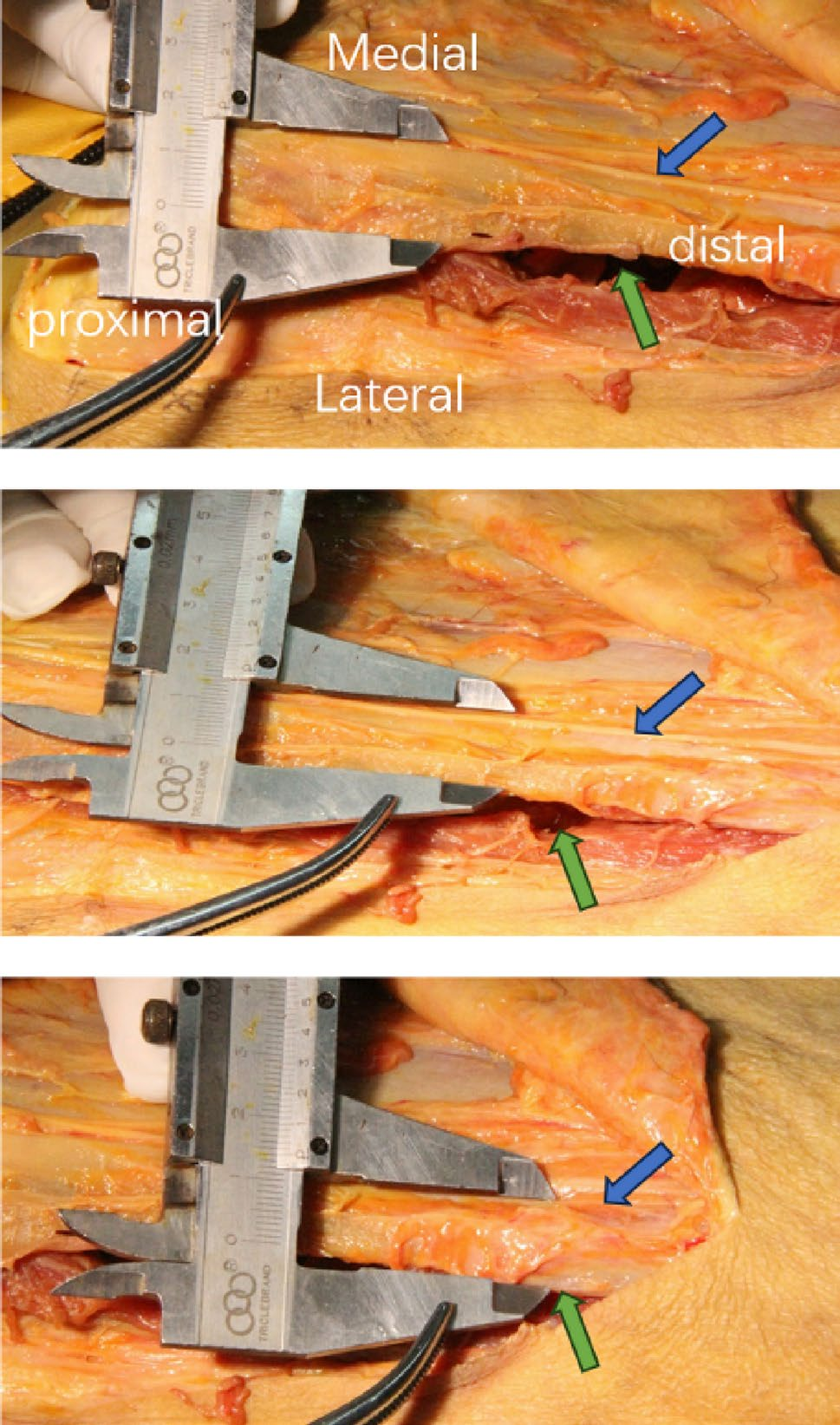 DAA全髋置换：关键解剖标志与操作要点