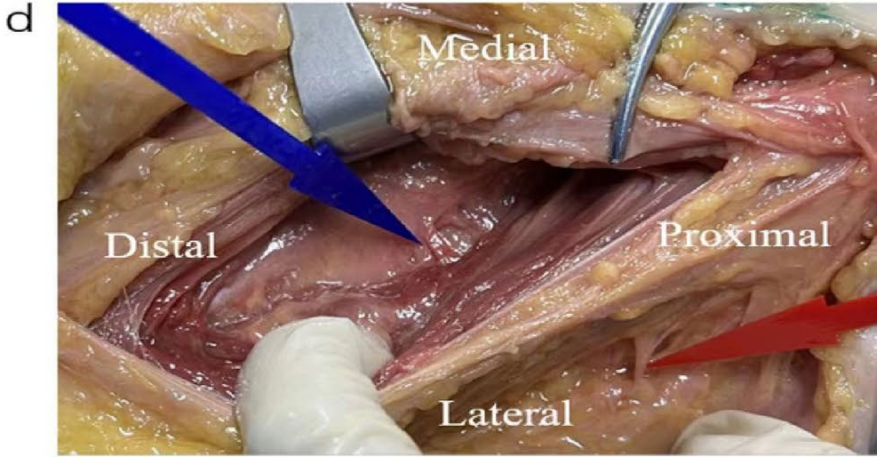 DAA全髋置换：关键解剖标志与操作要点