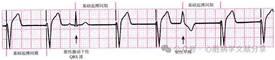 心脏起搏器参数的设定