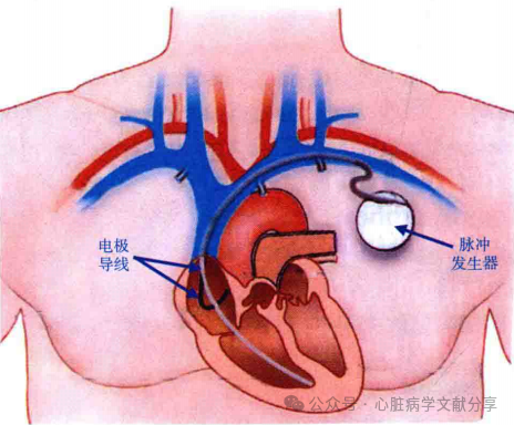 心脏起搏器参数的设定