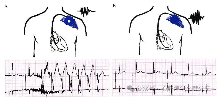心脏起搏器参数的设定