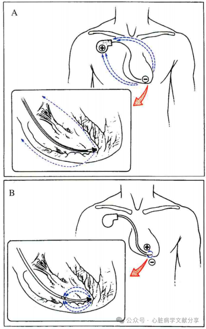 心脏起搏器参数的设定