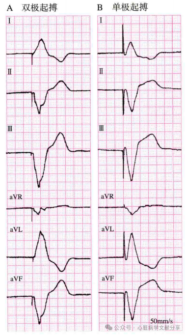 心脏起搏器参数的设定