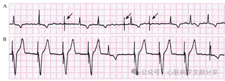 心脏起搏器参数的设定