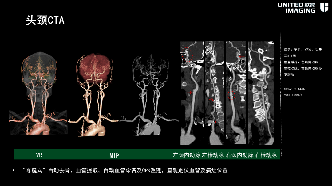 联影的CT怎么样造福剑川百姓，剑川县人民医院引进联影160排CT_https://www.jmylbn.com_新闻资讯_第23张