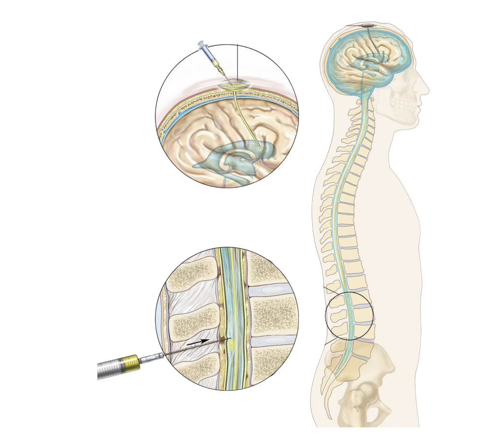 怎么上穿刺鞘【科普小站】肺癌软脑膜转移鞘内治疗最佳途径如何选择？_https://www.jmylbn.com_新闻资讯_第2张