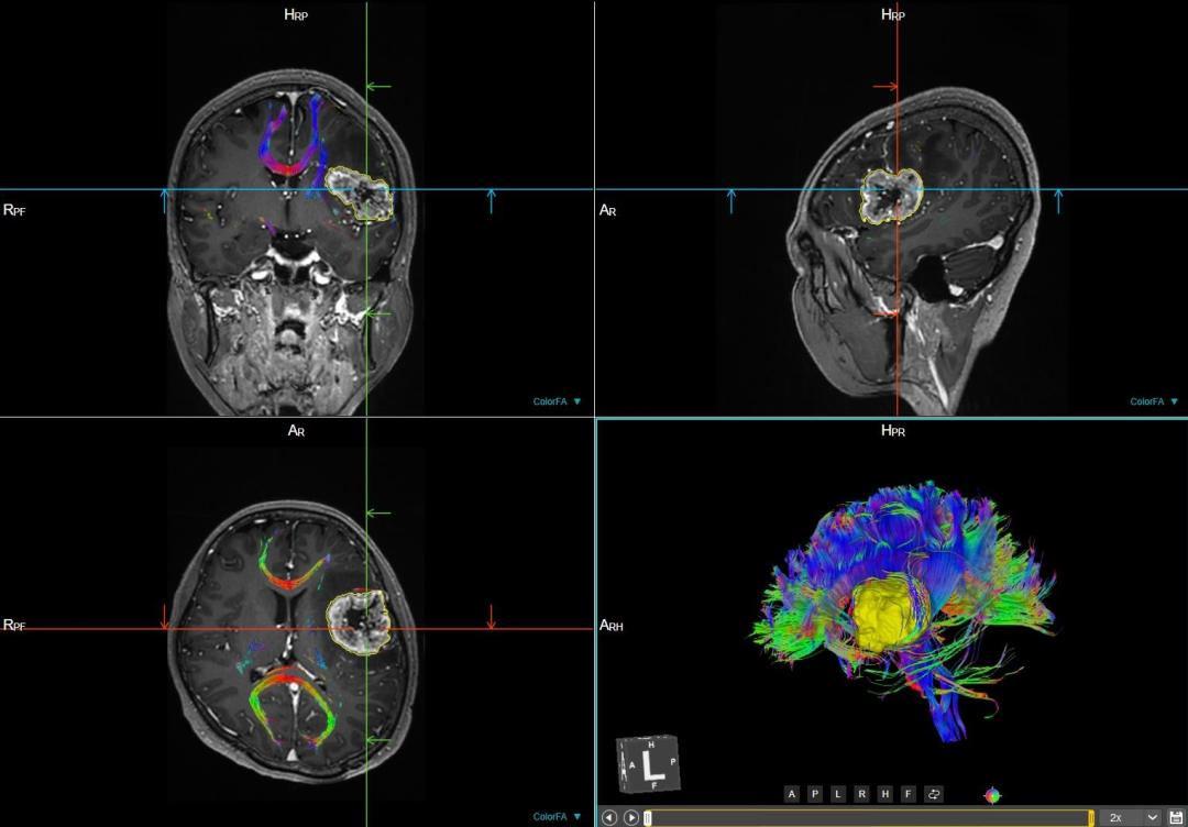 联影磁共振怎么样更先进、更高效、更精准—联影3.0T超导磁共振落户武城县人民医院_https://www.jmylbn.com_新闻资讯_第17张