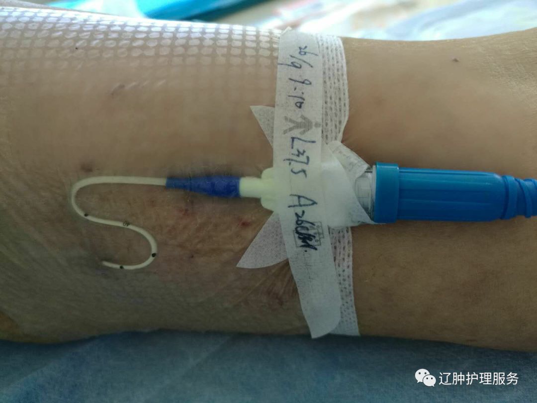怎么撕敷料啊PICC：0°揭敷料，Ω固定法，好经验快收藏！_https://www.jmylbn.com_新闻资讯_第8张